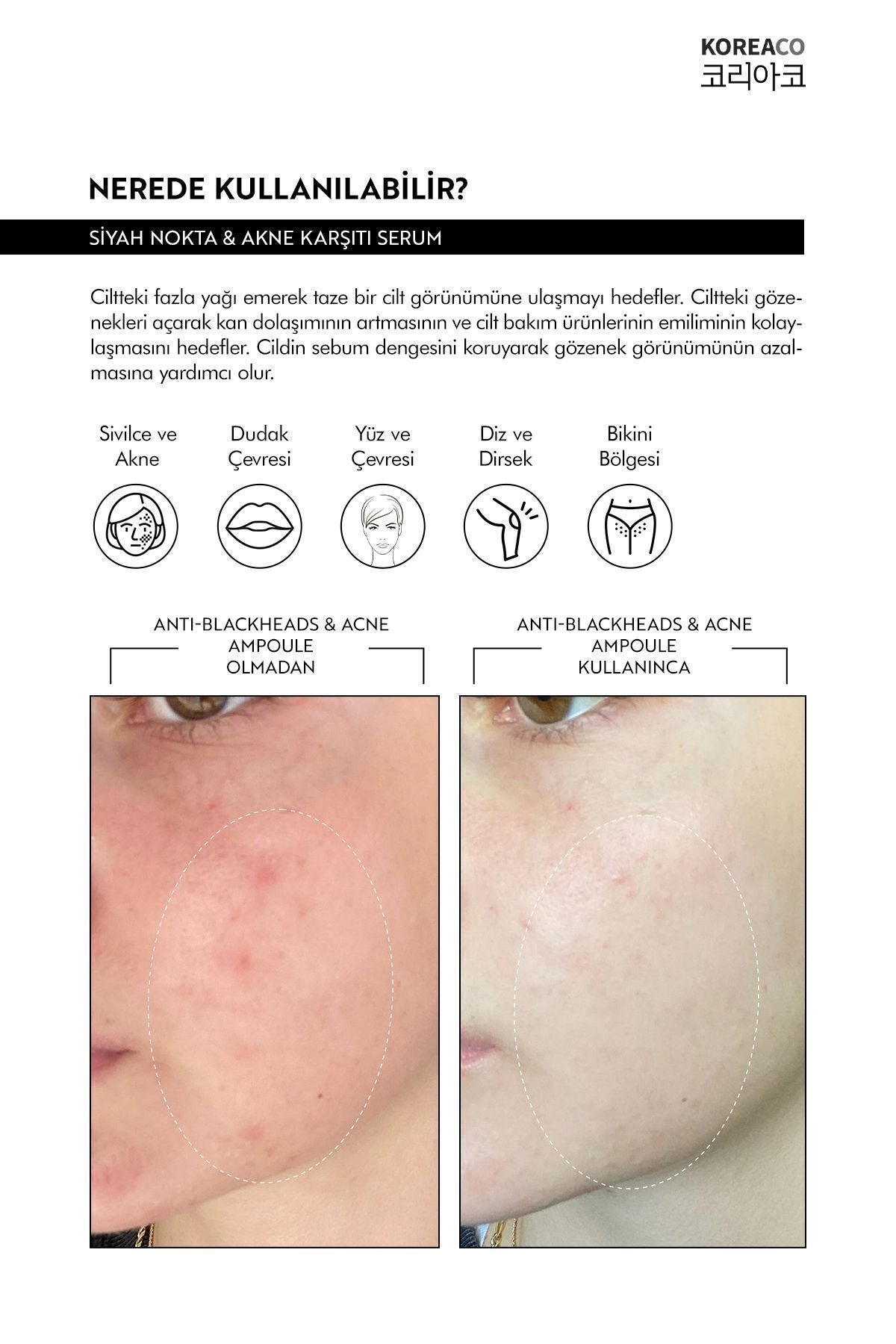 KOREACO Anti-Blackheads Acne Ampoule is a targeted skincare solution formulated to help keep pores clear and support a more balanced-looking complexion.